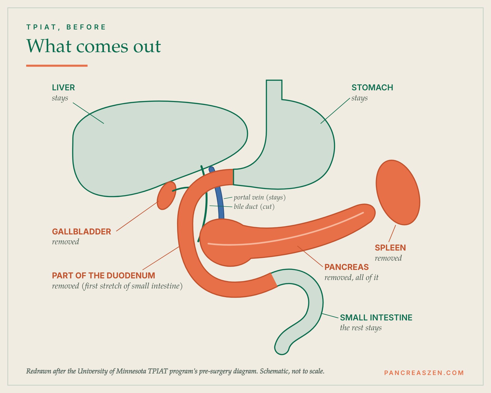 Diagram of what is removed in TPIAT surgery: pancreas, spleen, gallbladder and part of the duodenum