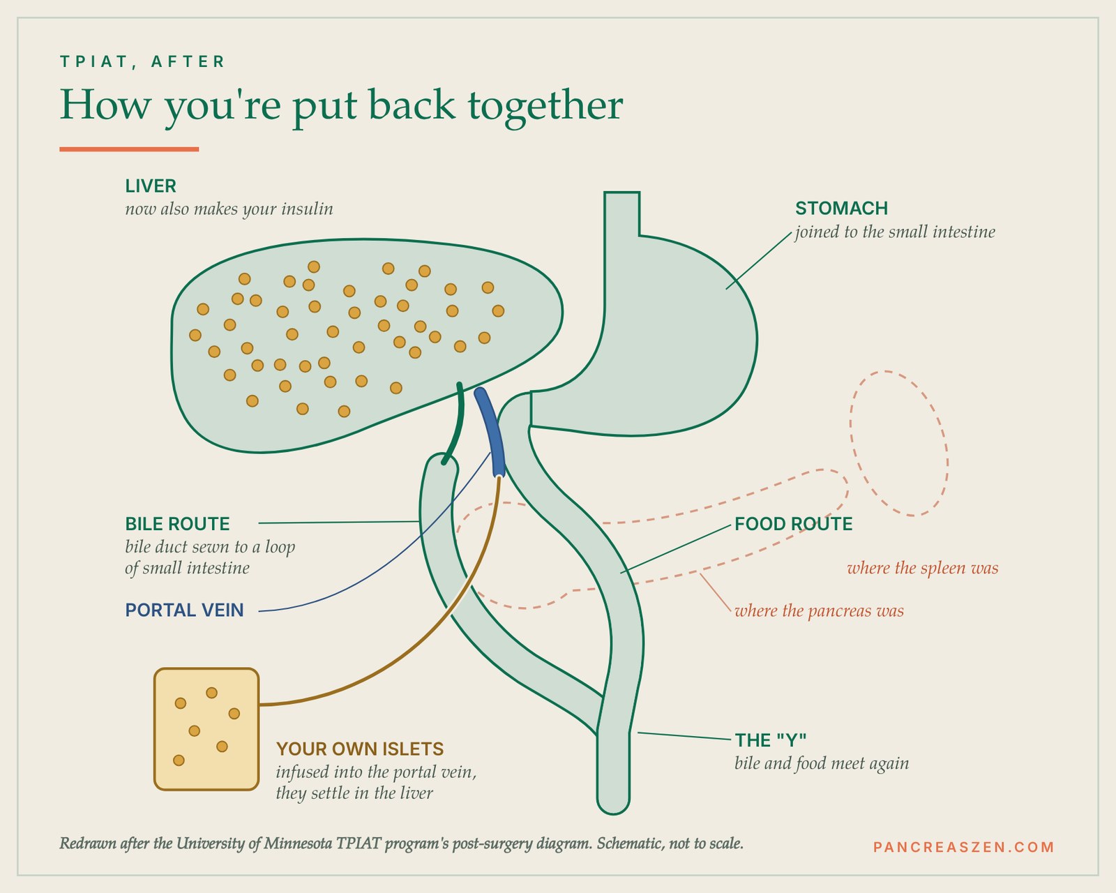 Diagram of the body after TPIAT: islets in the liver, stomach and bile duct joined to the small intestine